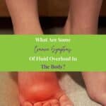 a person's with foot swelling