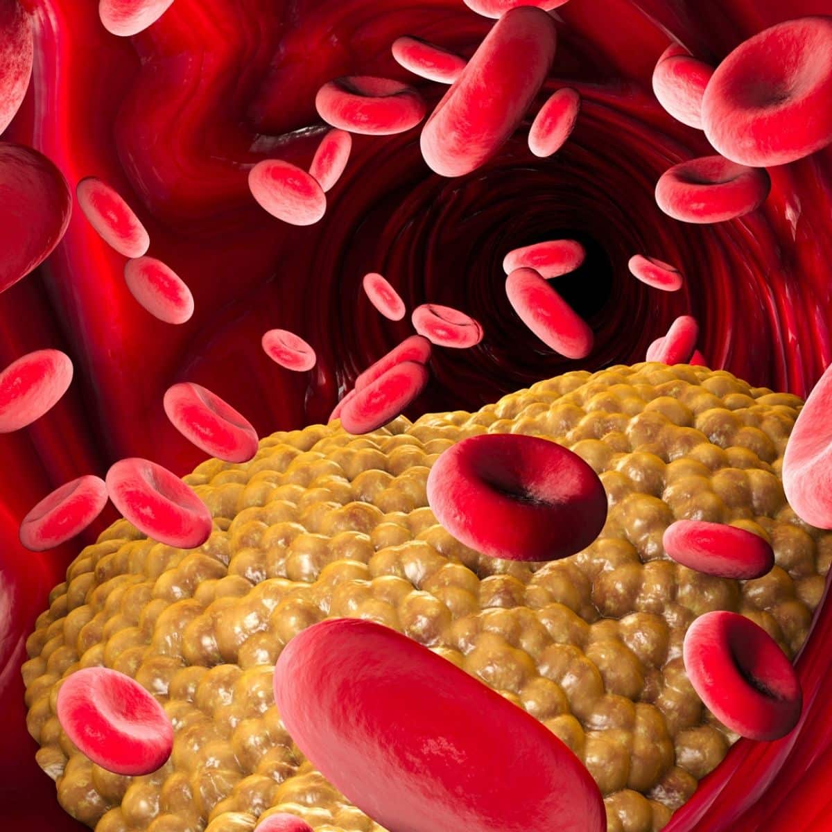 Cholesterol formation, fat, artery, vein, heart. Red blood cells, blood flow. Narrowing of a vein for fat formation.