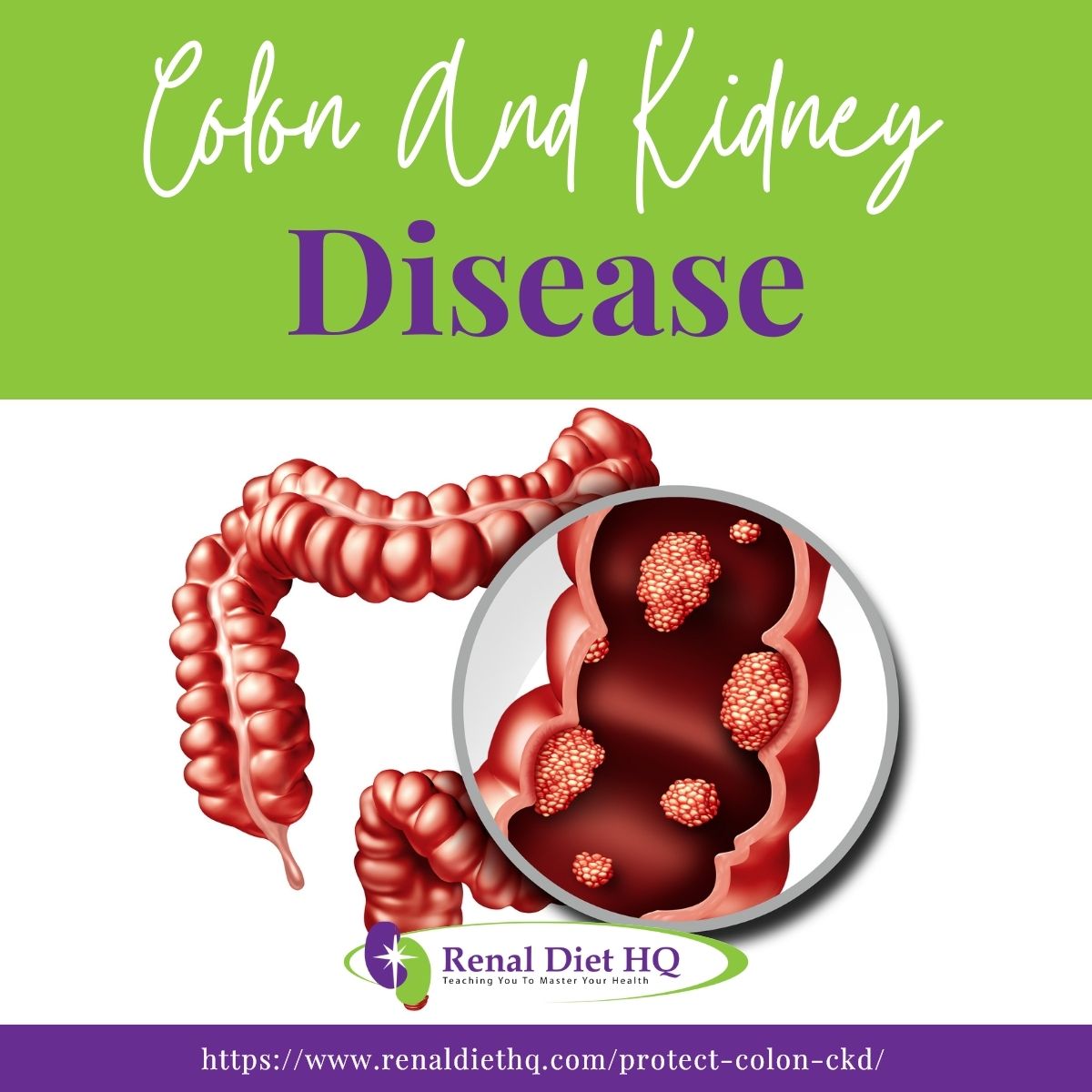 Illustration Colon Disease