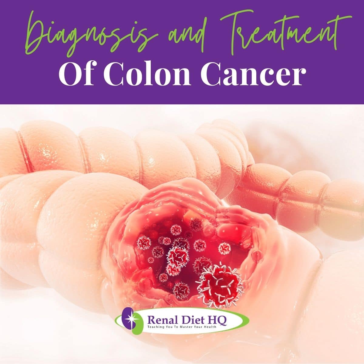 Cancer attacking cell. Colon disease concept.