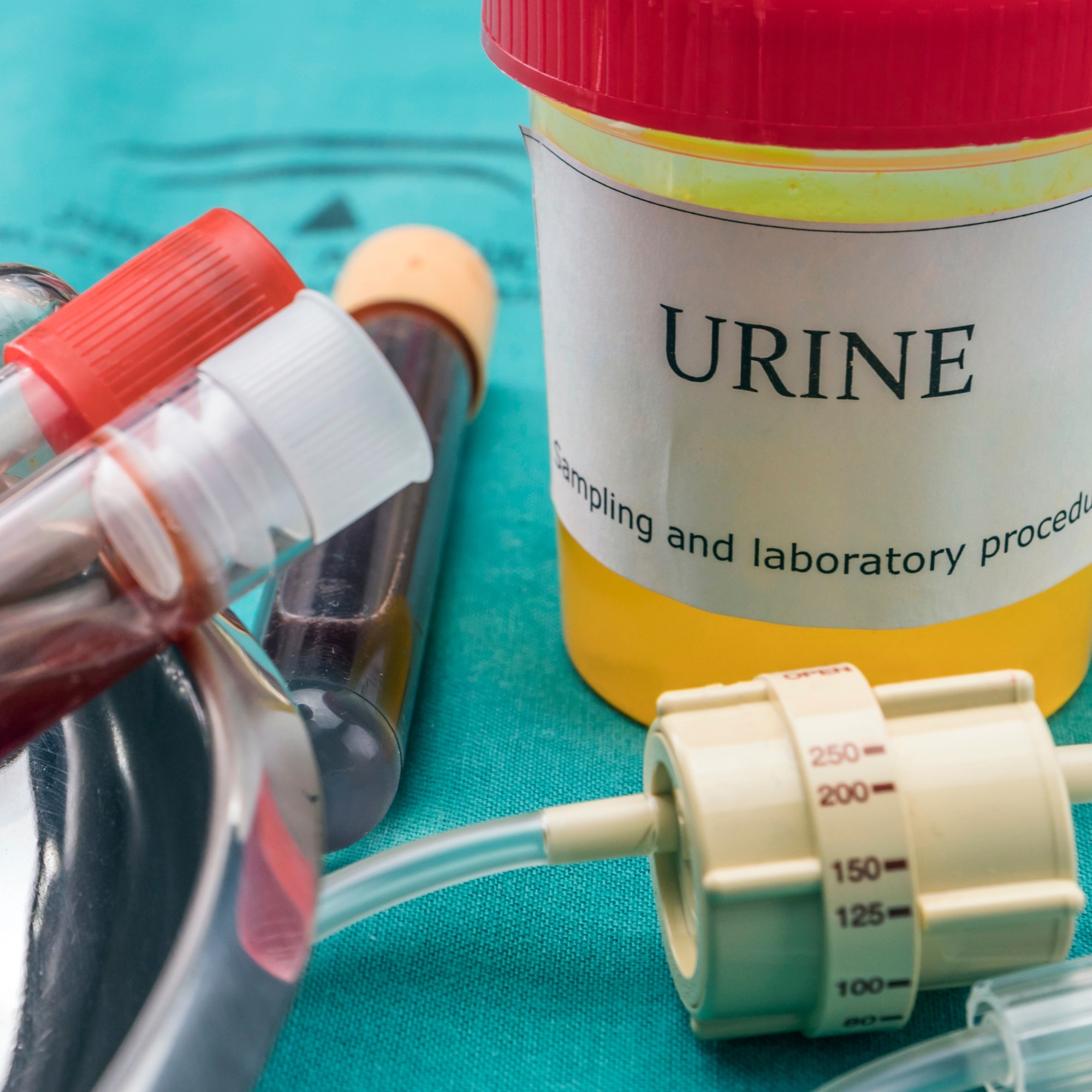 urine in a syringe on a table with a bottle of urine next to it